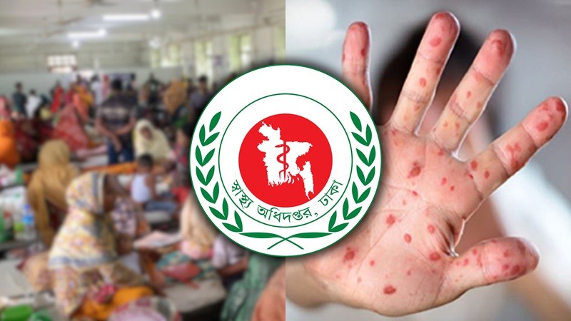 ২৪ ঘণ্টায় হামের উপসর্গে ৭ জনের মৃত্যু, হাসপাতালে ভর্তি ১,৩২৭